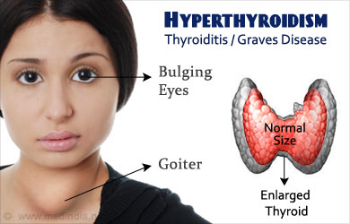 Hyperthyrodism
