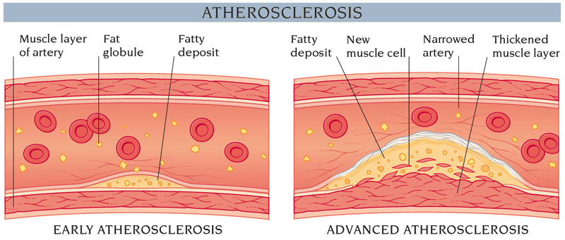 Arteriosclerosis and Atherosclerosis