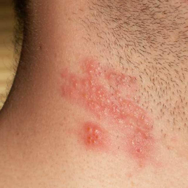 Shingle (Herpes Zoster)
