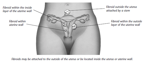fibroid on Uterus