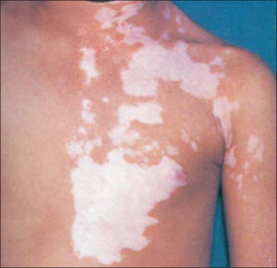 Vitiligo Leukoderma