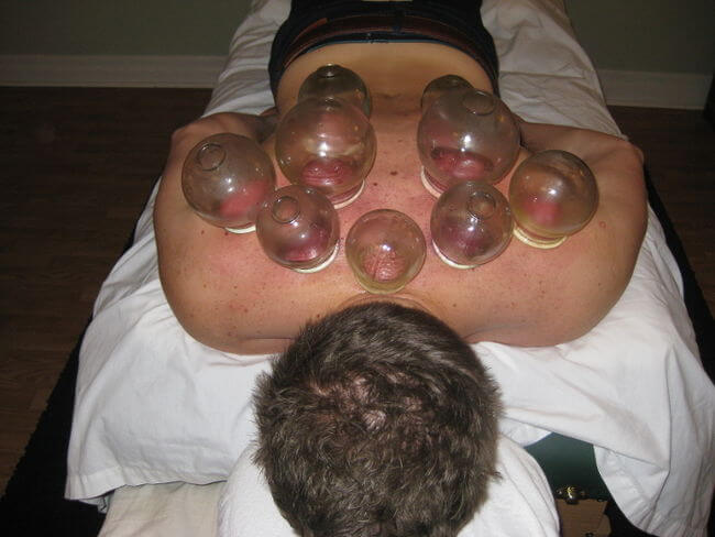 Cupping therapy 