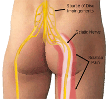 Sciatica and Back Pain