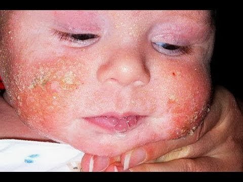 Baby Eczema on Face - Natural remedies for babies with eczema