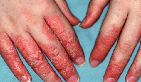 Dermatitis on hands 