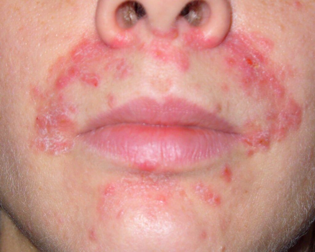 Dermatitis on face