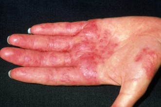Dermatitis on palms 