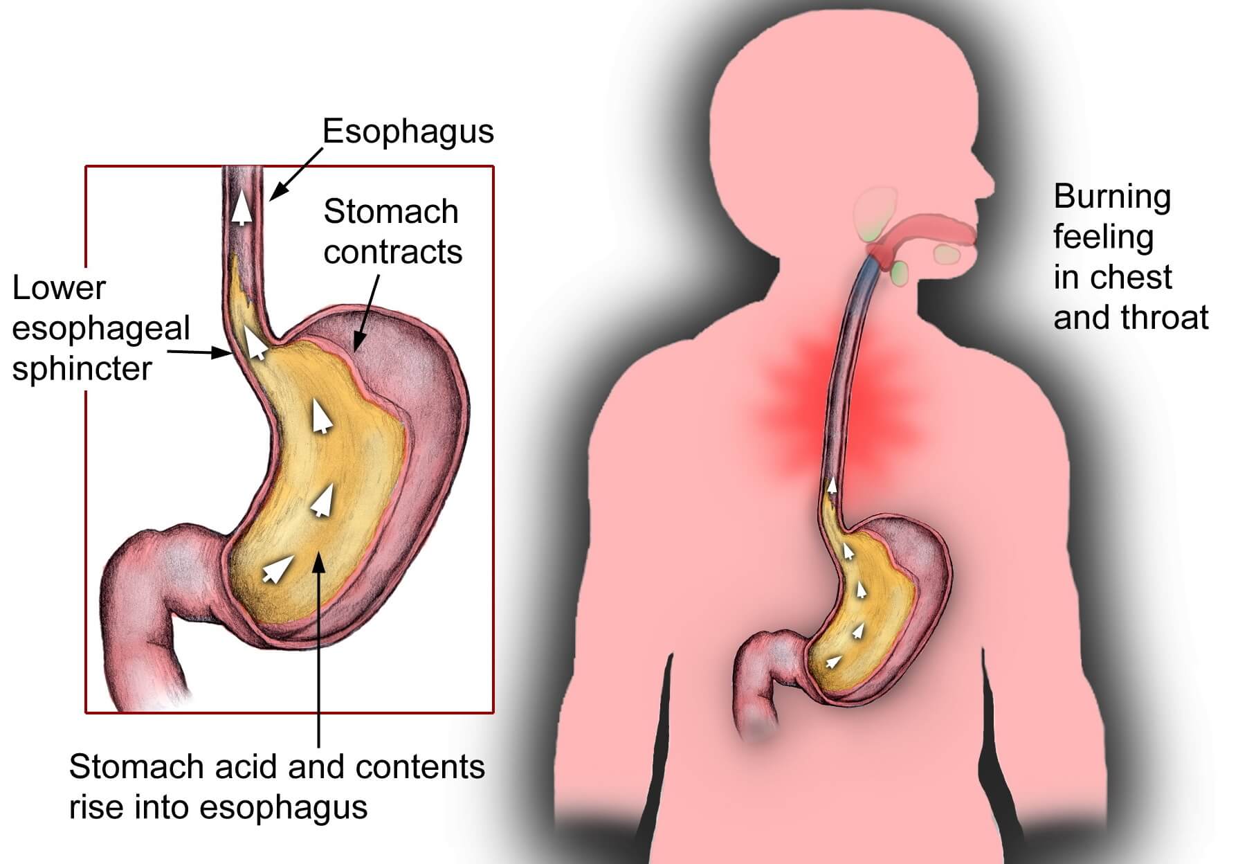 Home Remedies For Acid Reflux Philadelphia Homeopathic Clinic Dr Tsan