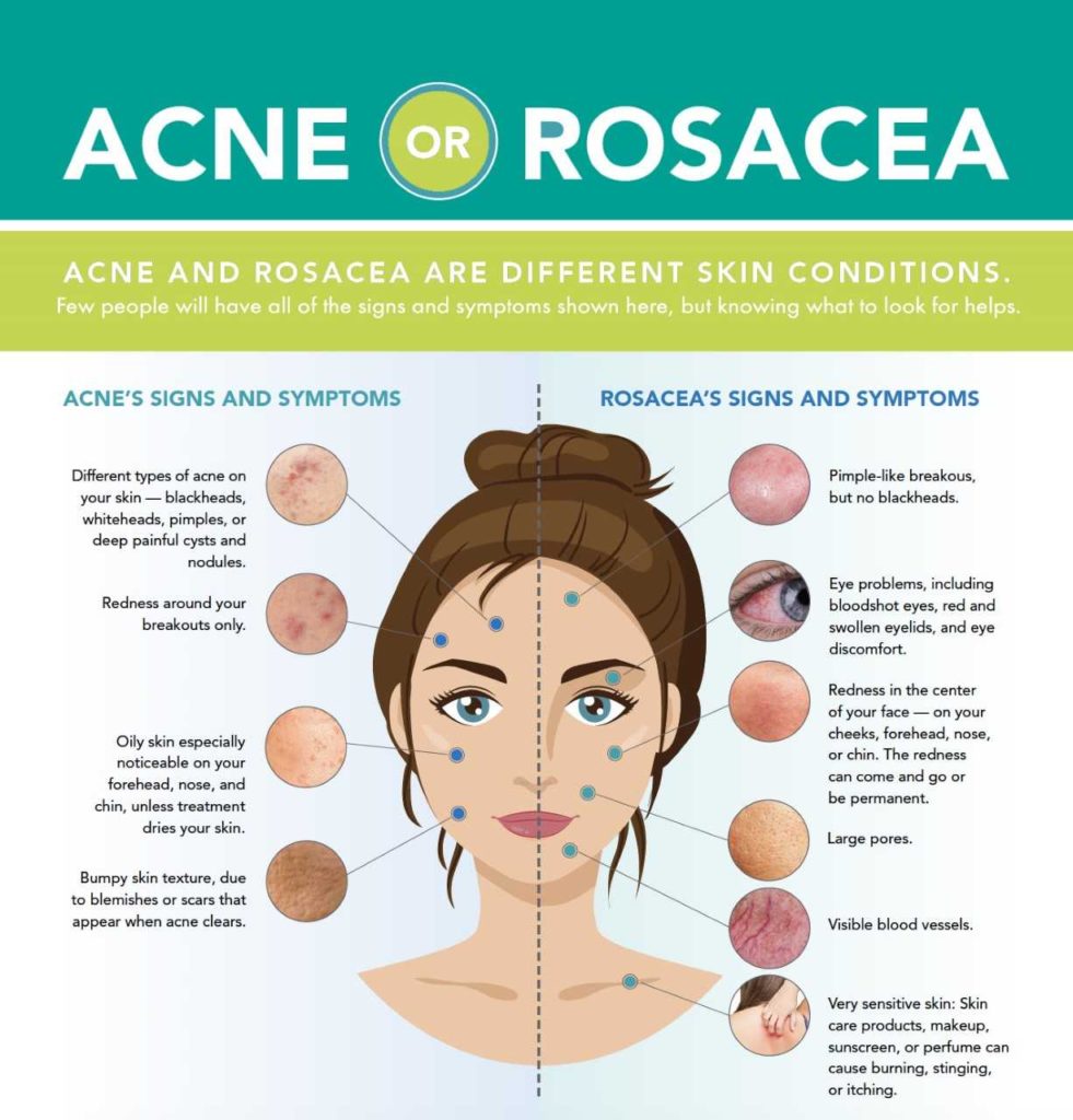 Acne vs. Rosacea