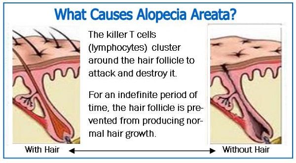 what causes alopecia areata