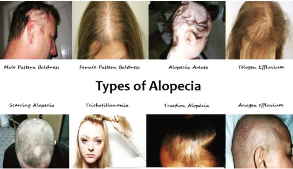 Types of alopecia areata