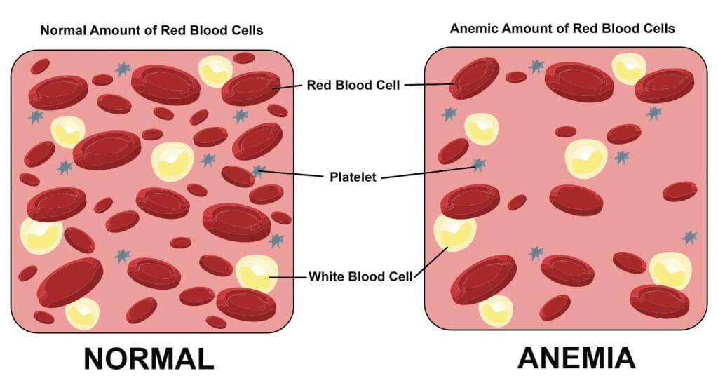 Low count of red blood cells