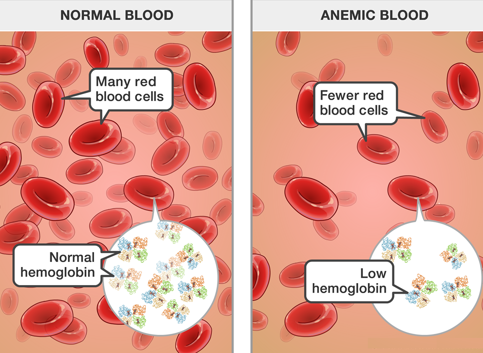 What is anemia