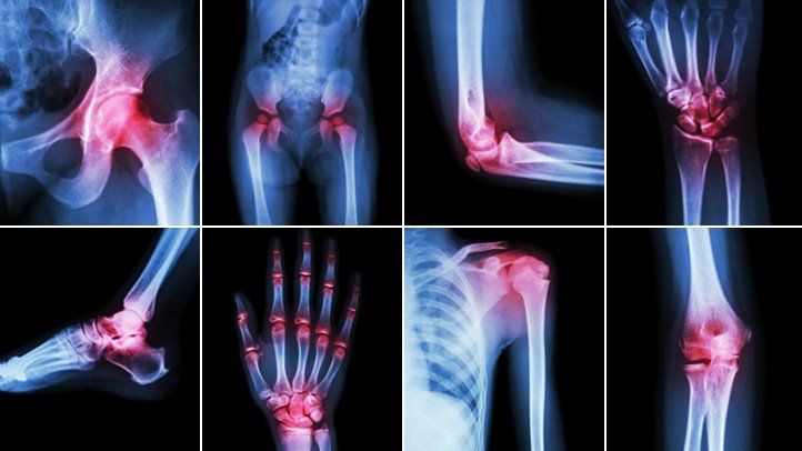 Treatment For Arthritis Philadelphia Homeopathic Clinic Dr Tsan Assoc