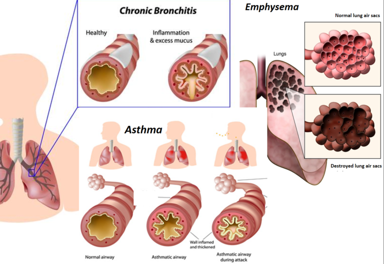 Asthma Treatment Philadelphia Homeopathic Clinic Dr. Tsan