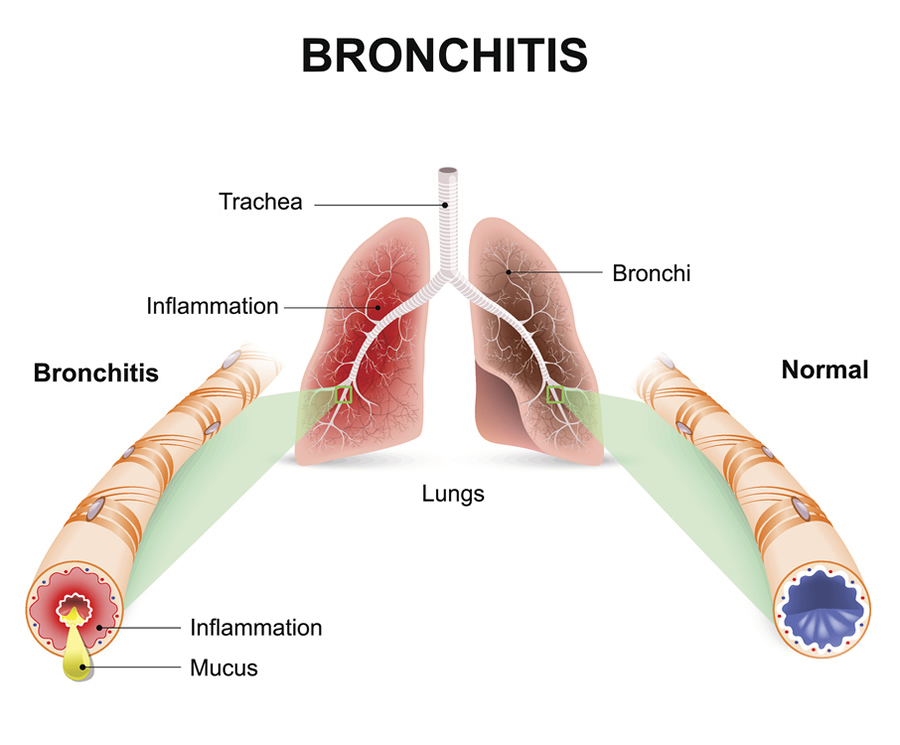 Bronchi's inflammation