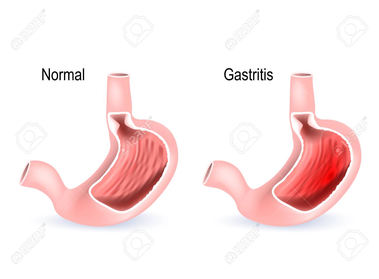 Treatment for Gastritis Philadelphia Homeopathic Clinic Dr Tsan & Assoc