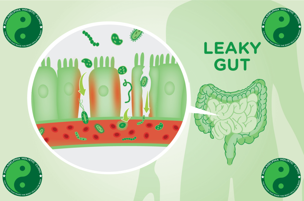 What is leaky gut syndrome