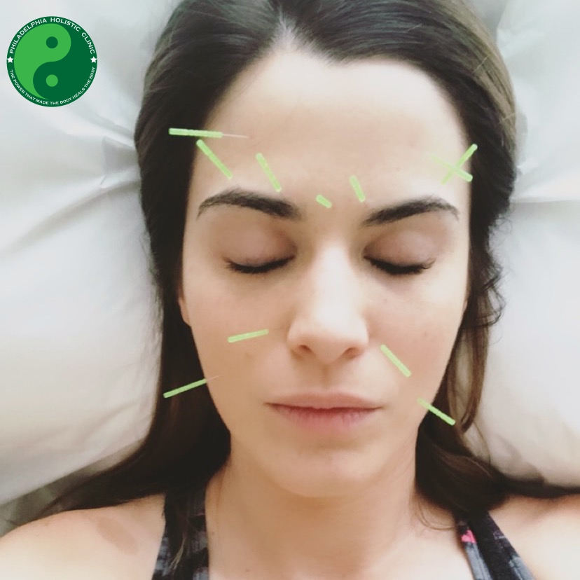 Acupuncture for Sinus Infection