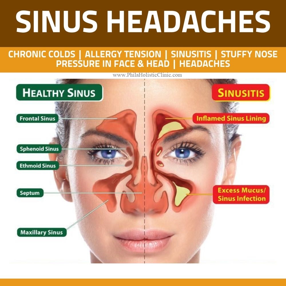 Headaches sinus