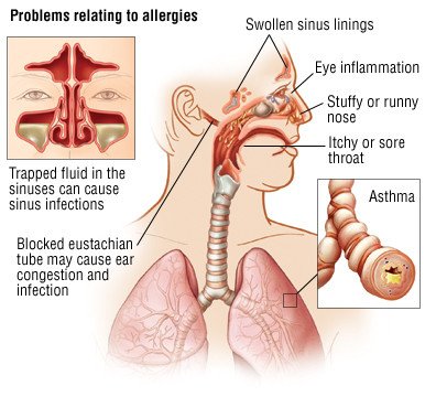 Mechanism of Allergic Rhinitis