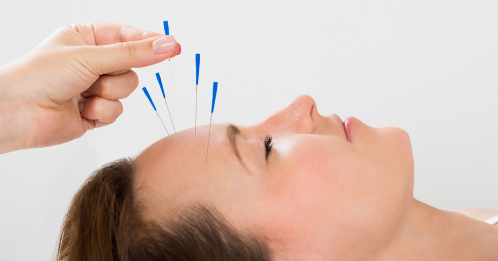 Migraines acupuncture