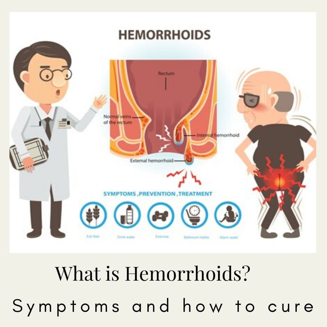 What Causes External Hemorrhoids