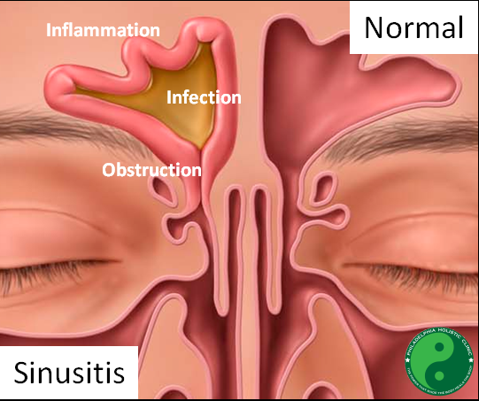 What is Sinusitis