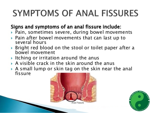 Fissures symptoms