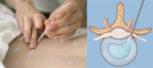 Back pain acupuncture