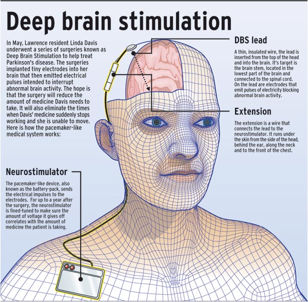 DBS - Deep-Brain-Stimulation - Surgical Treatment for Parkinson's disease