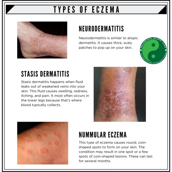 Types of eczema