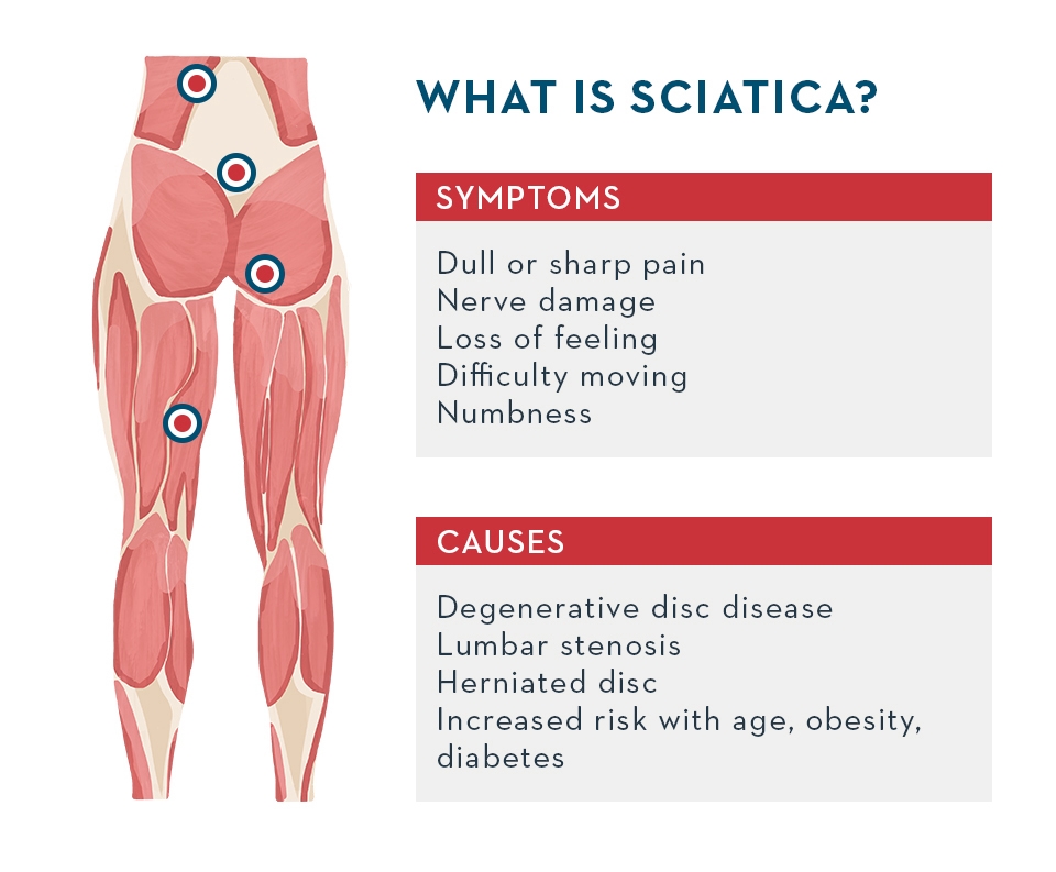 What is sciatica