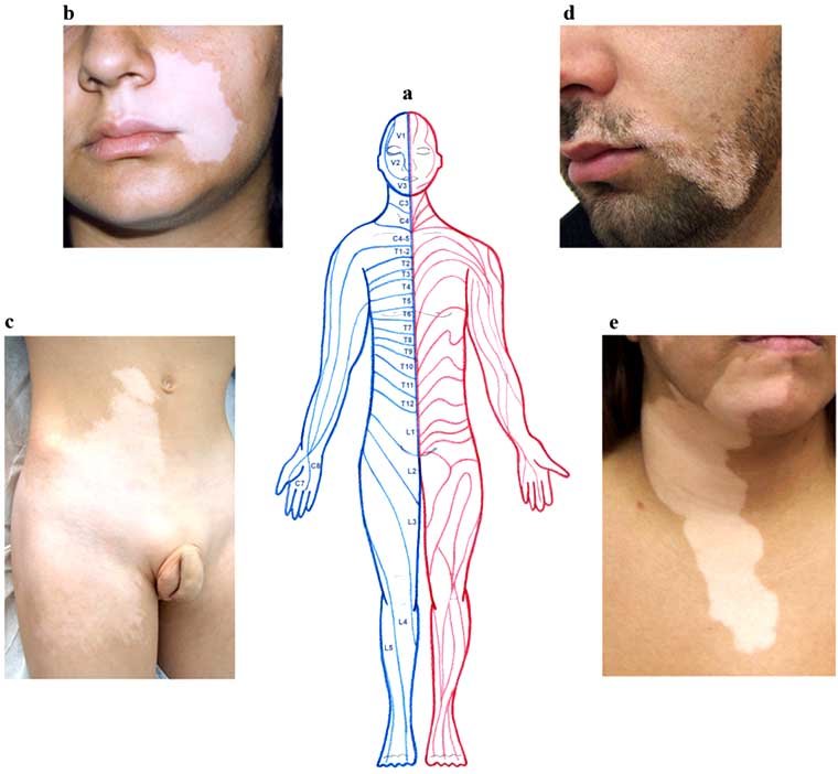 Segmental Vitiligo