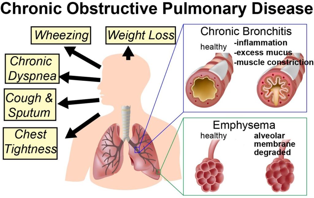 Symptoms of Chronic Obstructive Pulmonary Disease