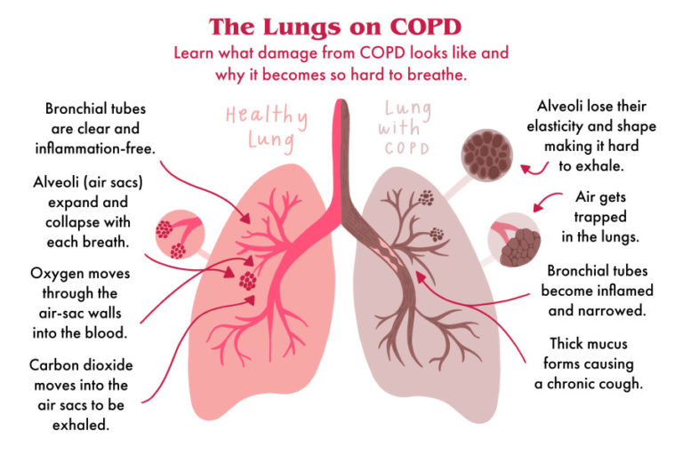Treatment for COPD Philadelphia Homeopathic Clinic Dr. Tsan & Team