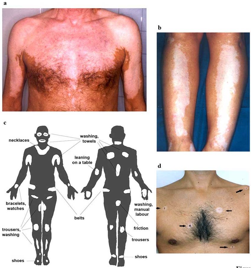 non segmental vitiligo