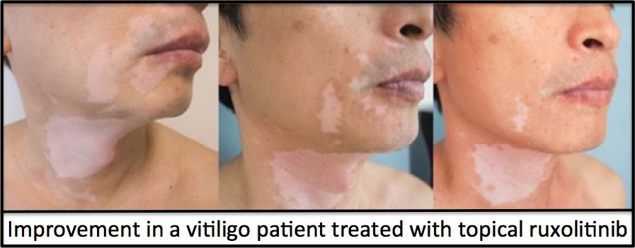 topical creams for vitiligo