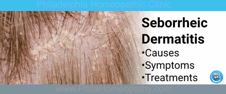 Seborrheic dermatitis - causes and symptoms