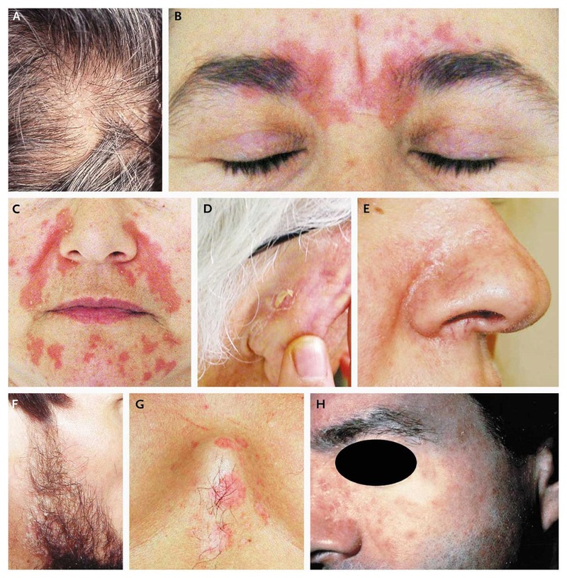 Symptoms of Seborrheic eczema