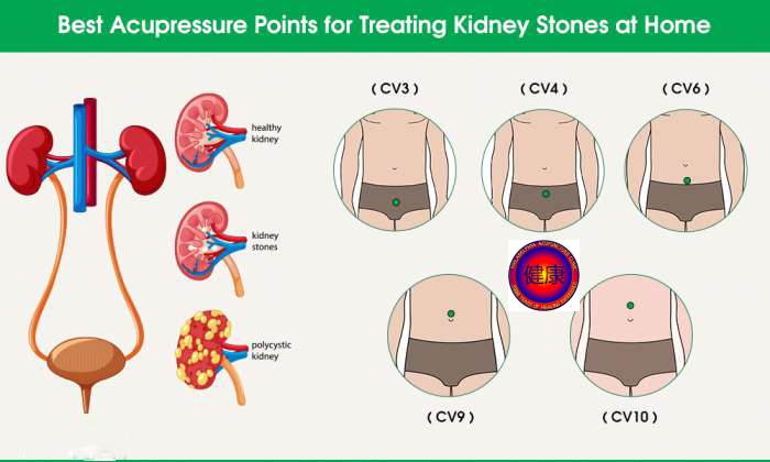 Acupuncture for kidney stones