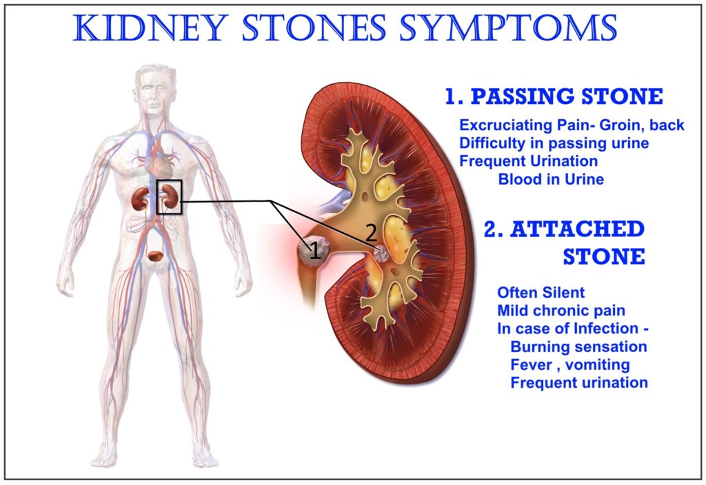 Kidney stones symptoms