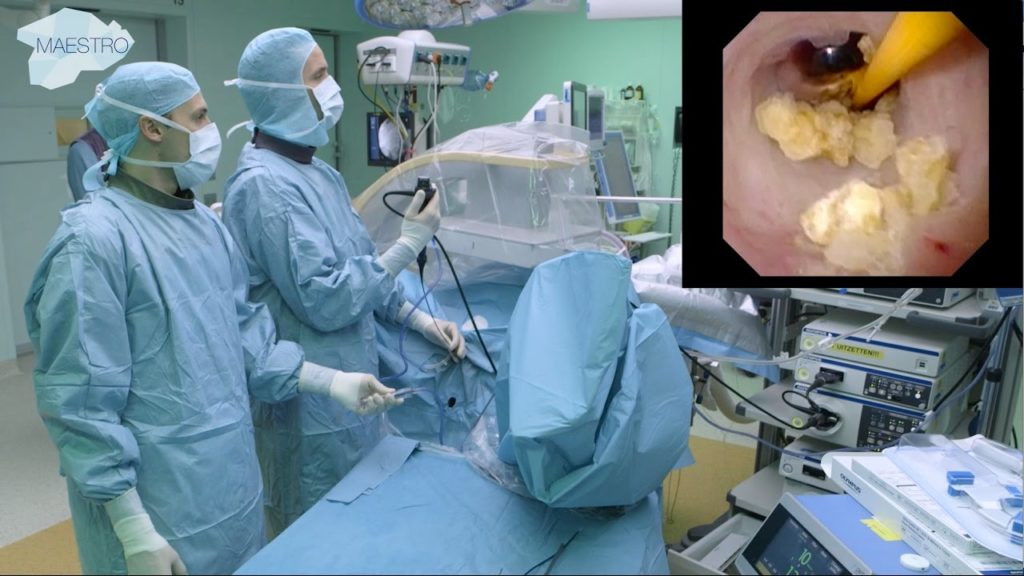 Surgery for renal calcis
