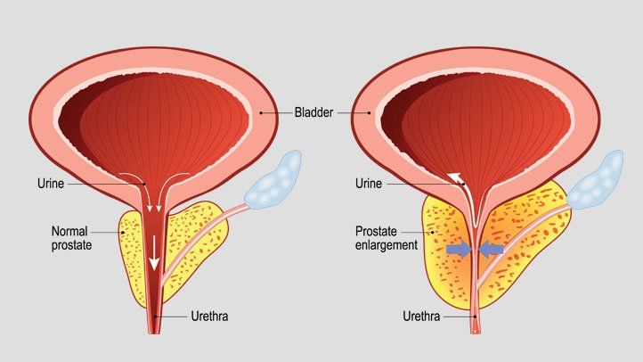 BPH - prostate enlargement