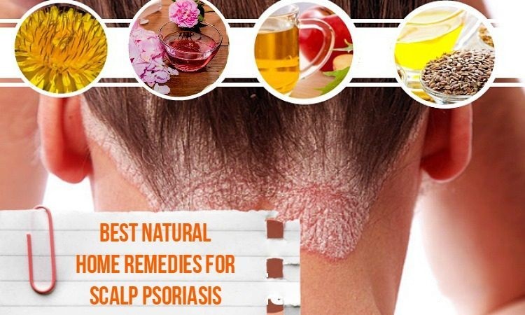  natural treatments for psoriasis