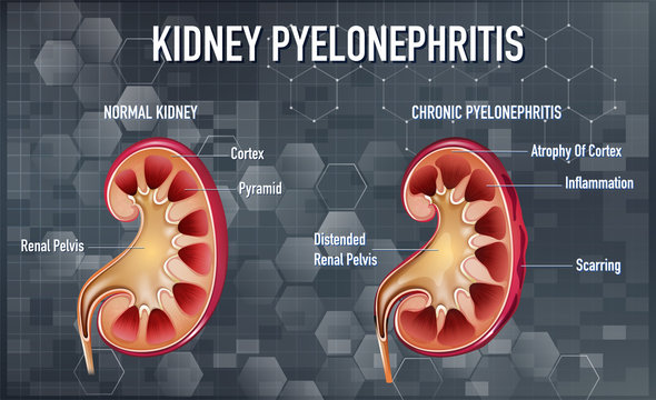 Kidney infection - Pyelonephritis