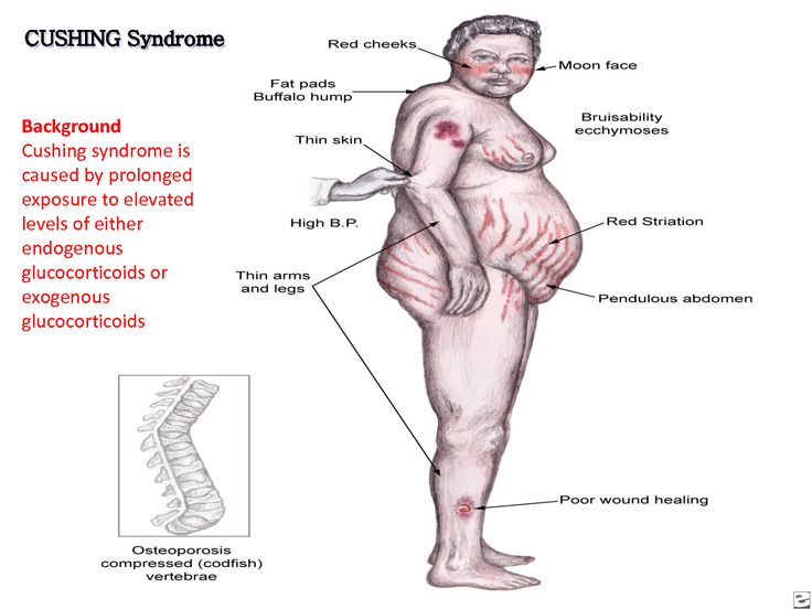 Cushing's syndrome - causes, symptoms, and treatment