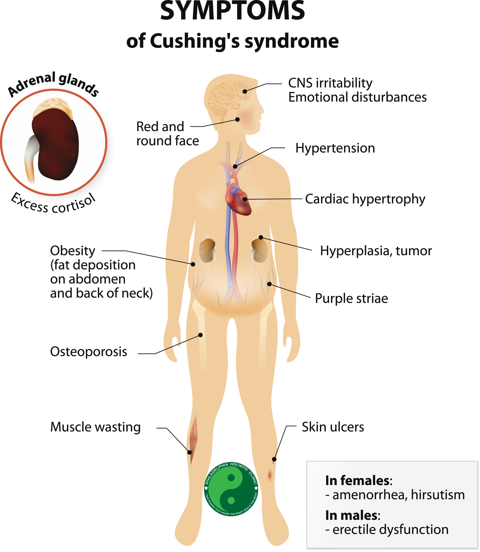 Symptoms and treatment of Cushing's syndrome