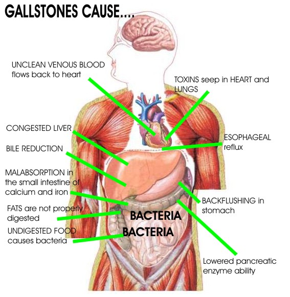 causes of stones in gallbladder