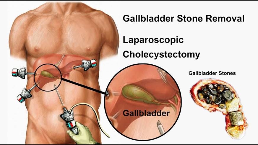 Surgery for gallstones